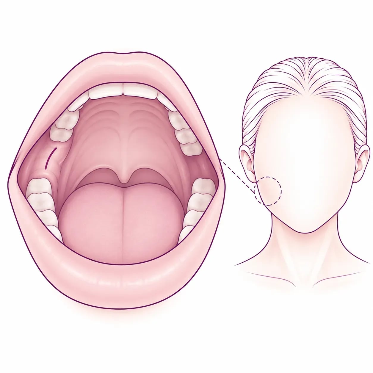 Incision de la bichectomie réalisée à l'intérieur de la joue, sans cicatrice visible sur la peau