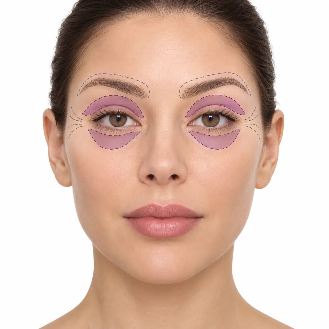 Zones traitées par une blépharoplastie : paupières supérieures et poches sous les yeux, contrairement aux pattes d'oie et aux sourcils