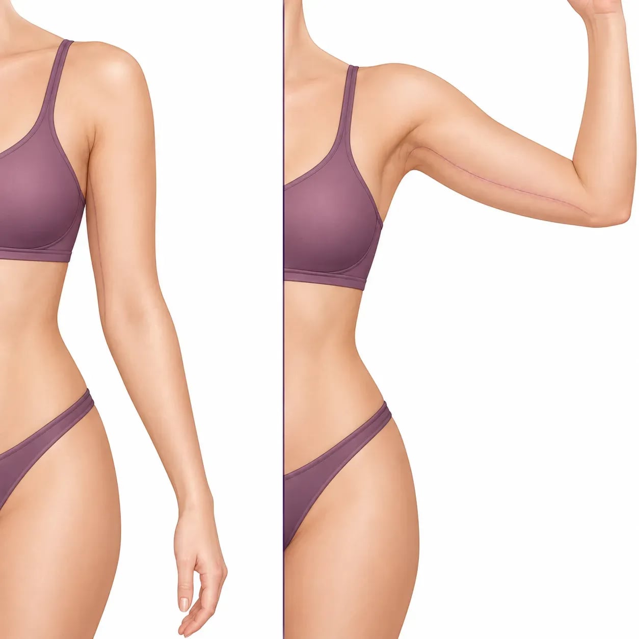 Position de la cicatrice d'un lifting des bras, sur la face interne, bras baissé et bras levé