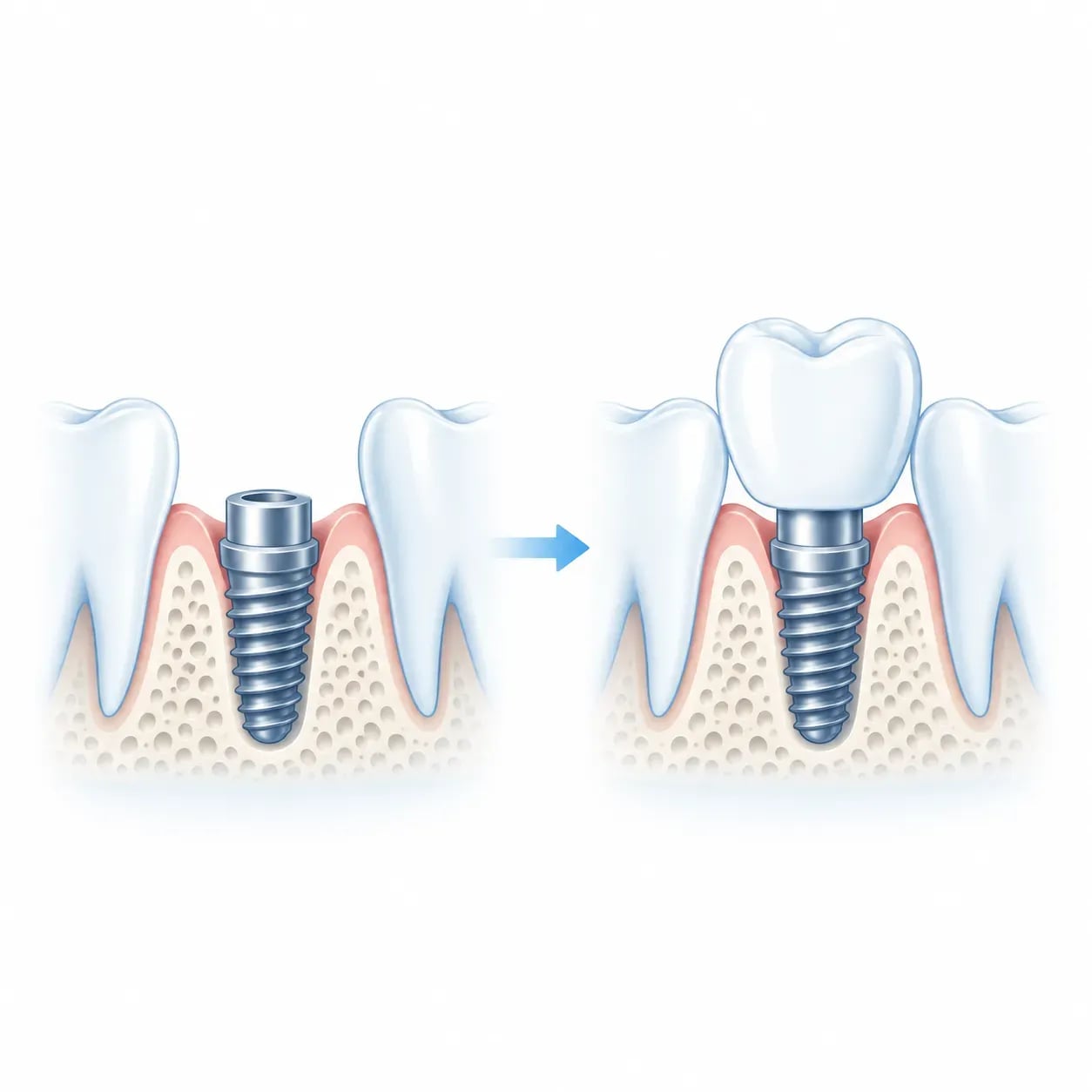 Schéma des 2 étapes de la pose d'un implant dentaire