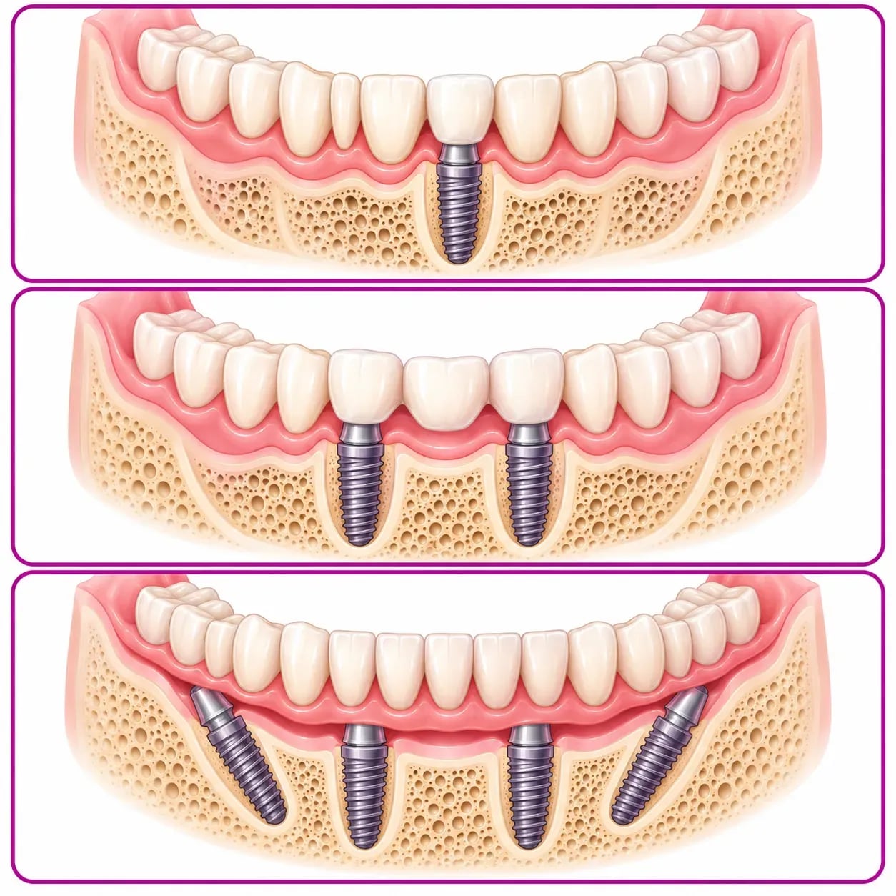 Implant unique, bridge sur implants et arcade complète de type All-on-4