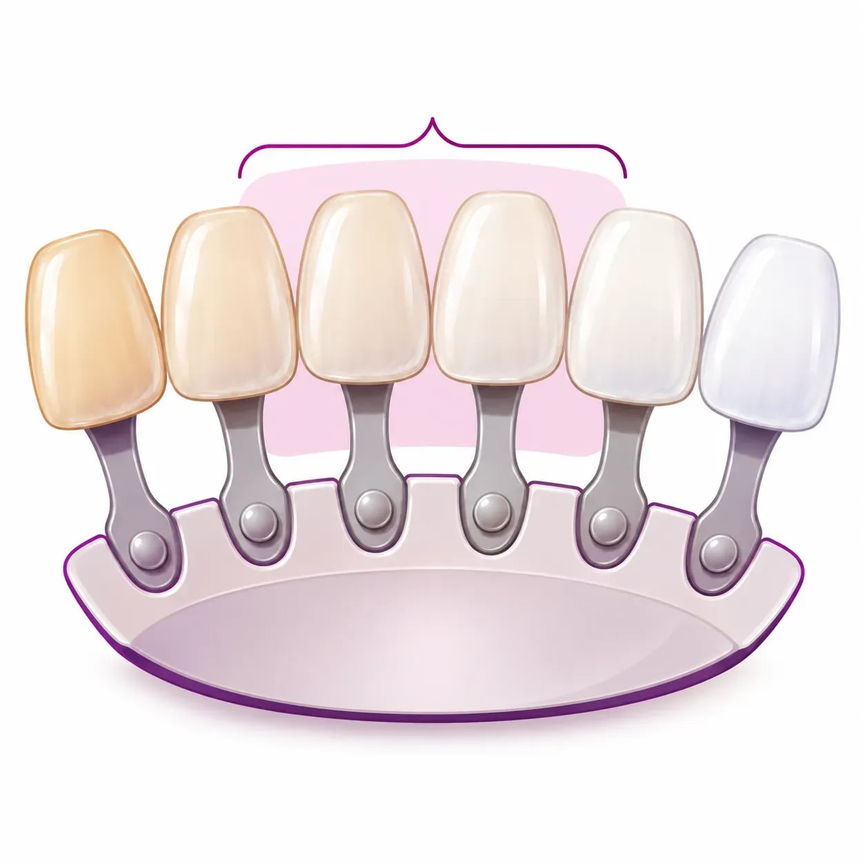 Nuancier de teintes utilisé pour choisir la couleur des facettes dentaires