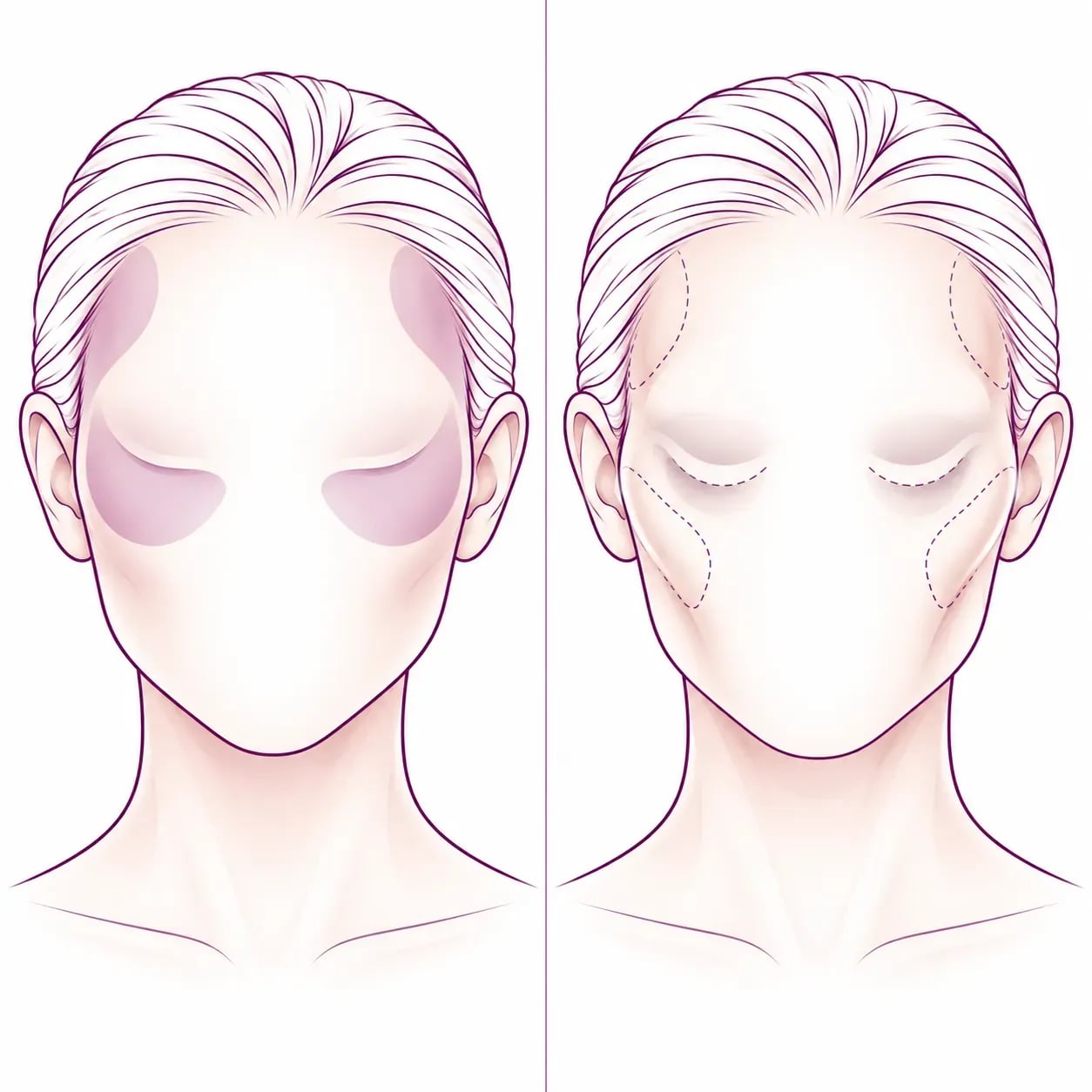 Perte de volume du visage avec l'âge : tempes, pommettes et cernes qui se creusent