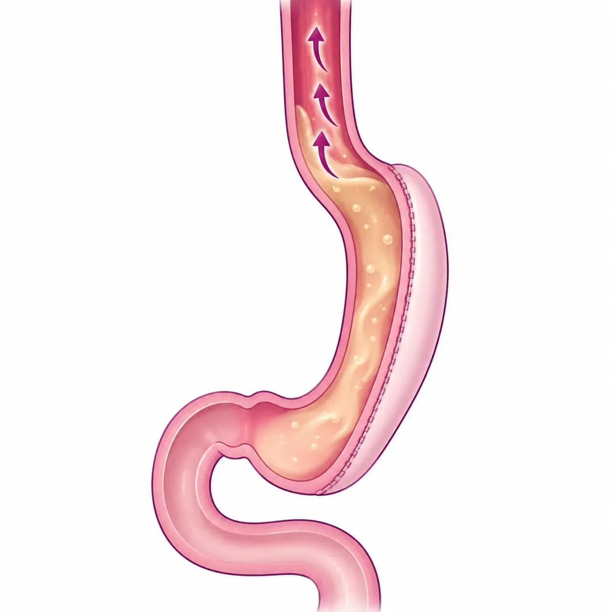Reflux gastro-œsophagien après une sleeve gastrique