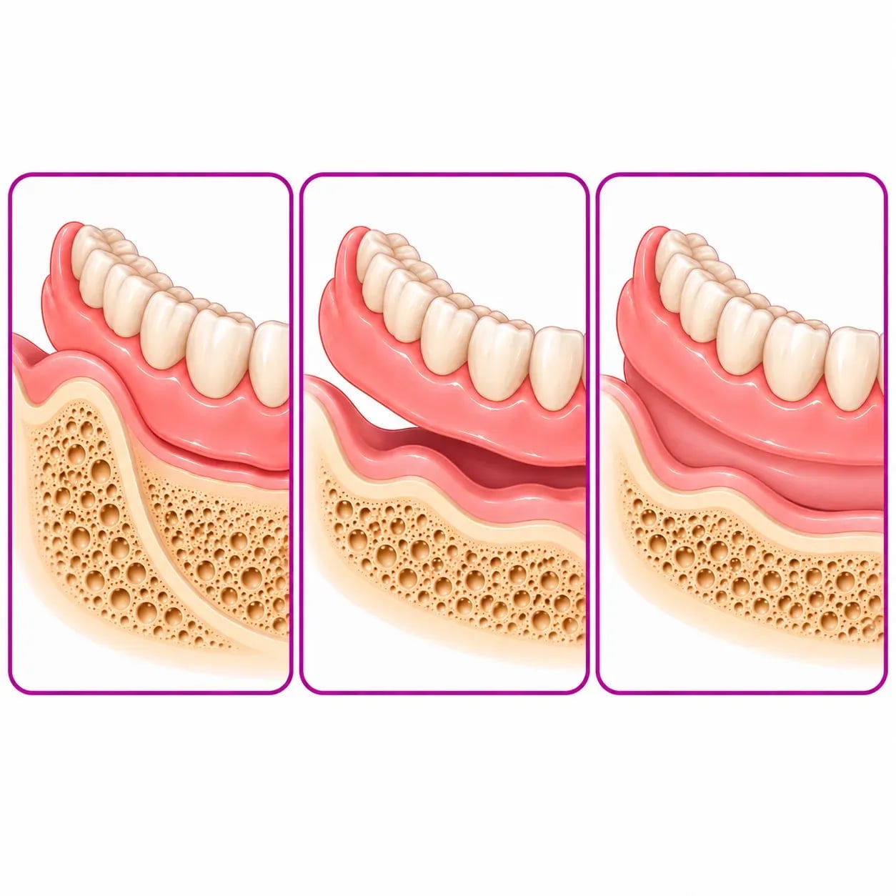 Résorption osseuse sous une prothèse amovible et correction par rebasage