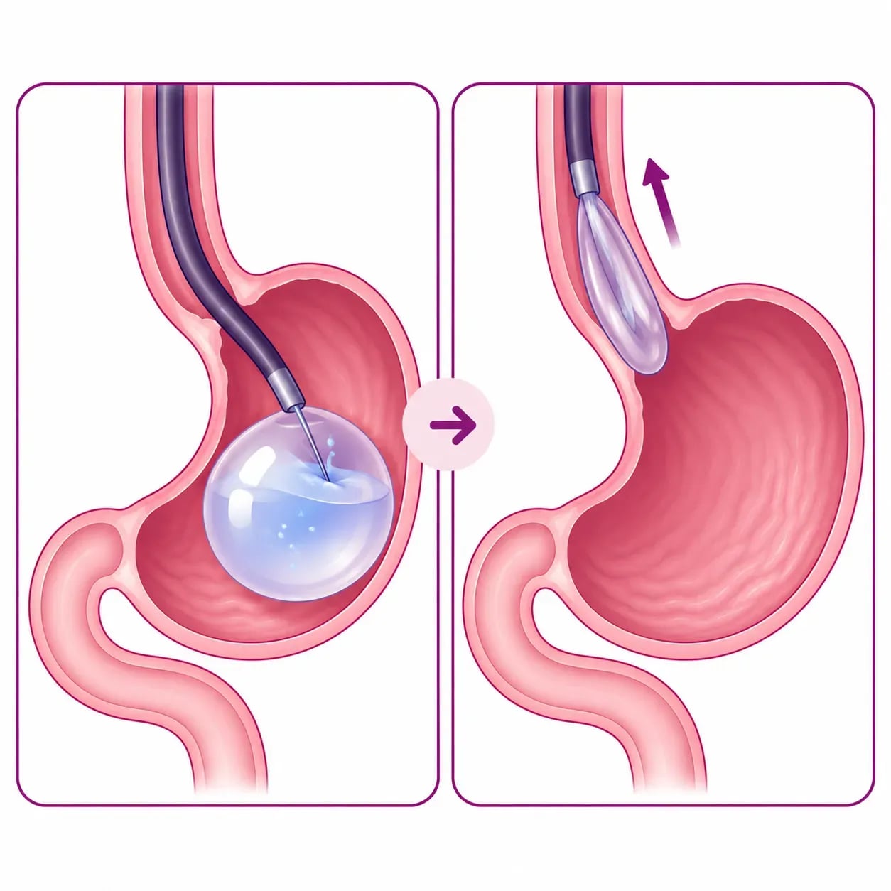 Retrait d'un ballon gastrique par endoscopie : vidange puis extraction par la bouche