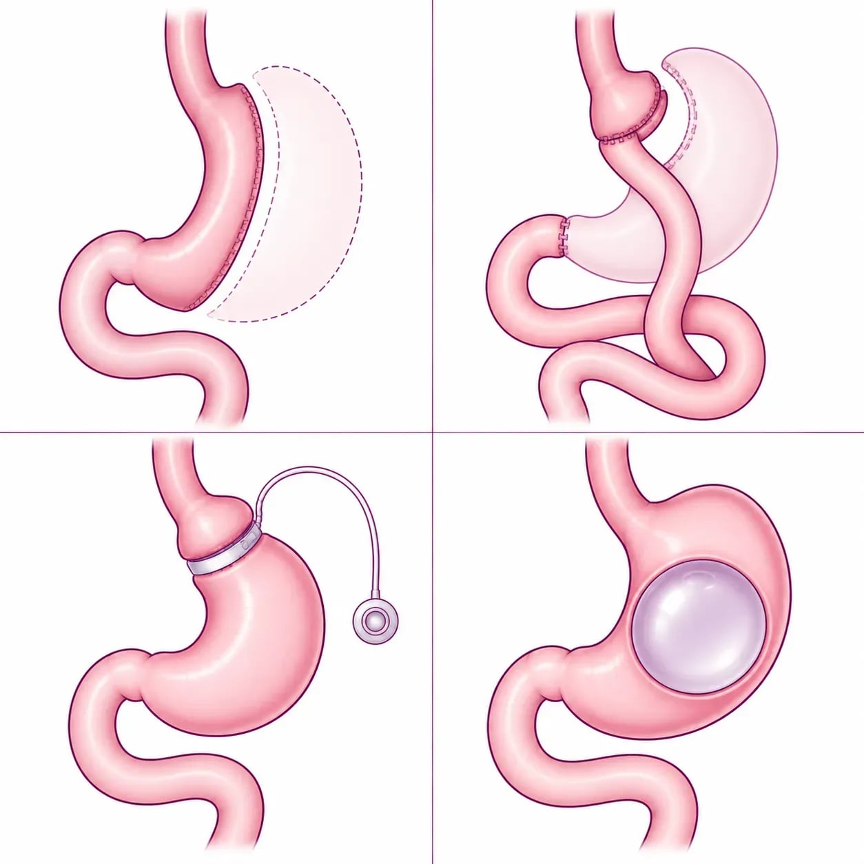 Comparaison de la sleeve gastrique, du bypass, de l'anneau gastrique et du ballon gastrique