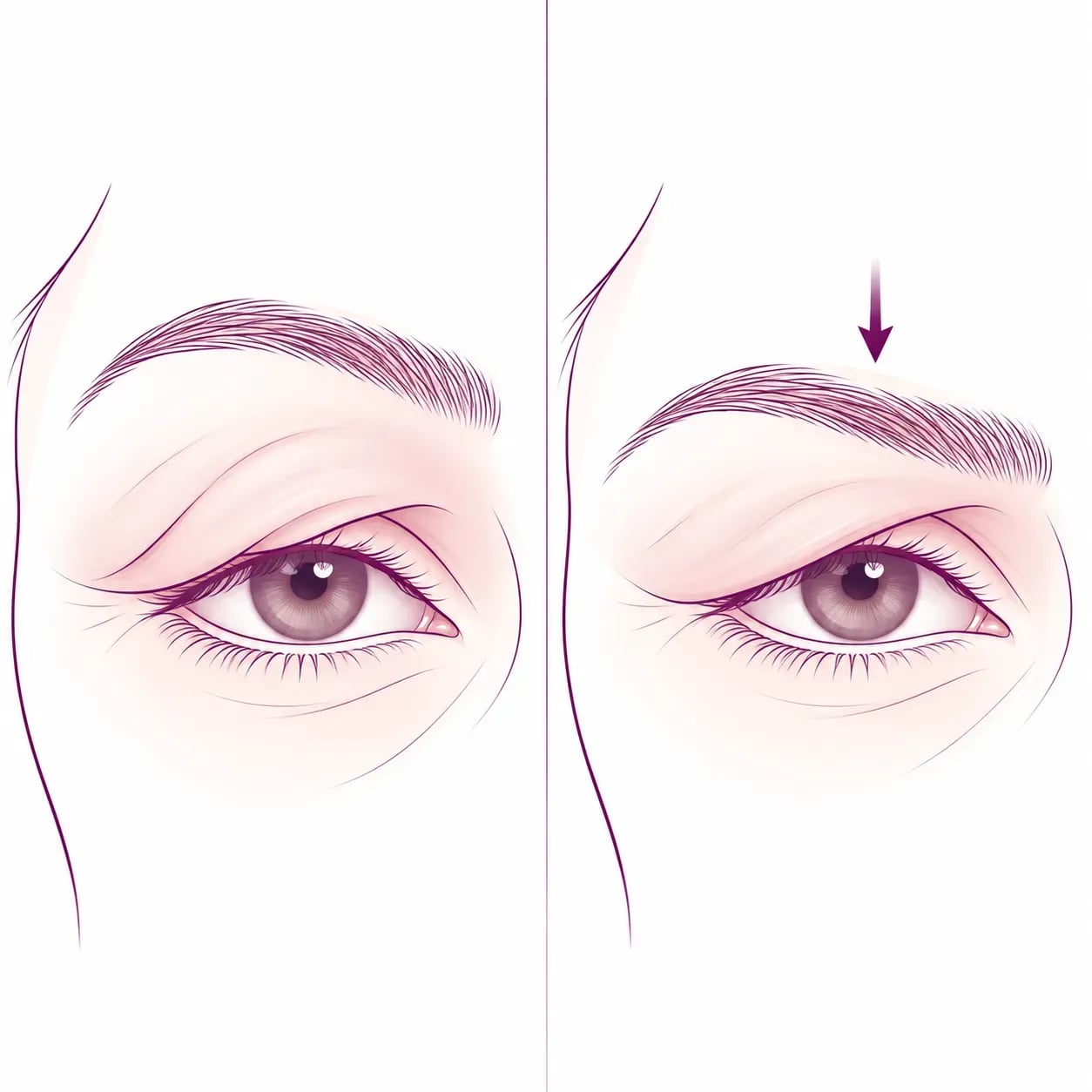 Différence entre un excès de peau de la paupière et un sourcil tombant donnant un aspect similaire