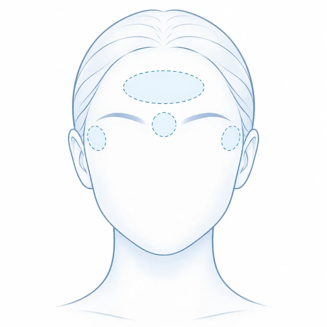 Schéma des 3 zones du visage traitées par une injection de Botox