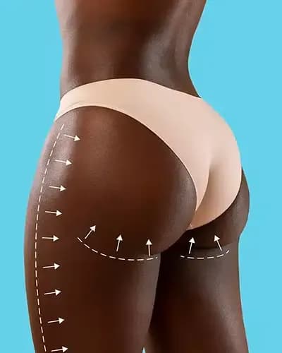 Brazilian Butt Lift (BBL) en Tunisie pour des fesses galbées naturellement