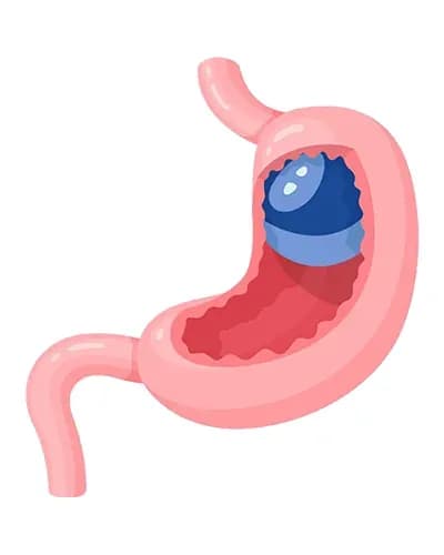 Ballon gastrique 12 mois posé par endoscopie en Tunisie