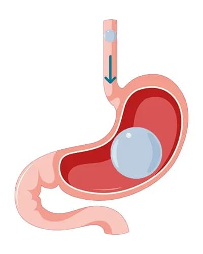 Ballon gastrique 6 mois posé par endoscopie en Tunisie
