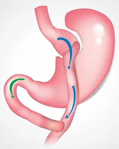 Bypass gastrique en Tunisie