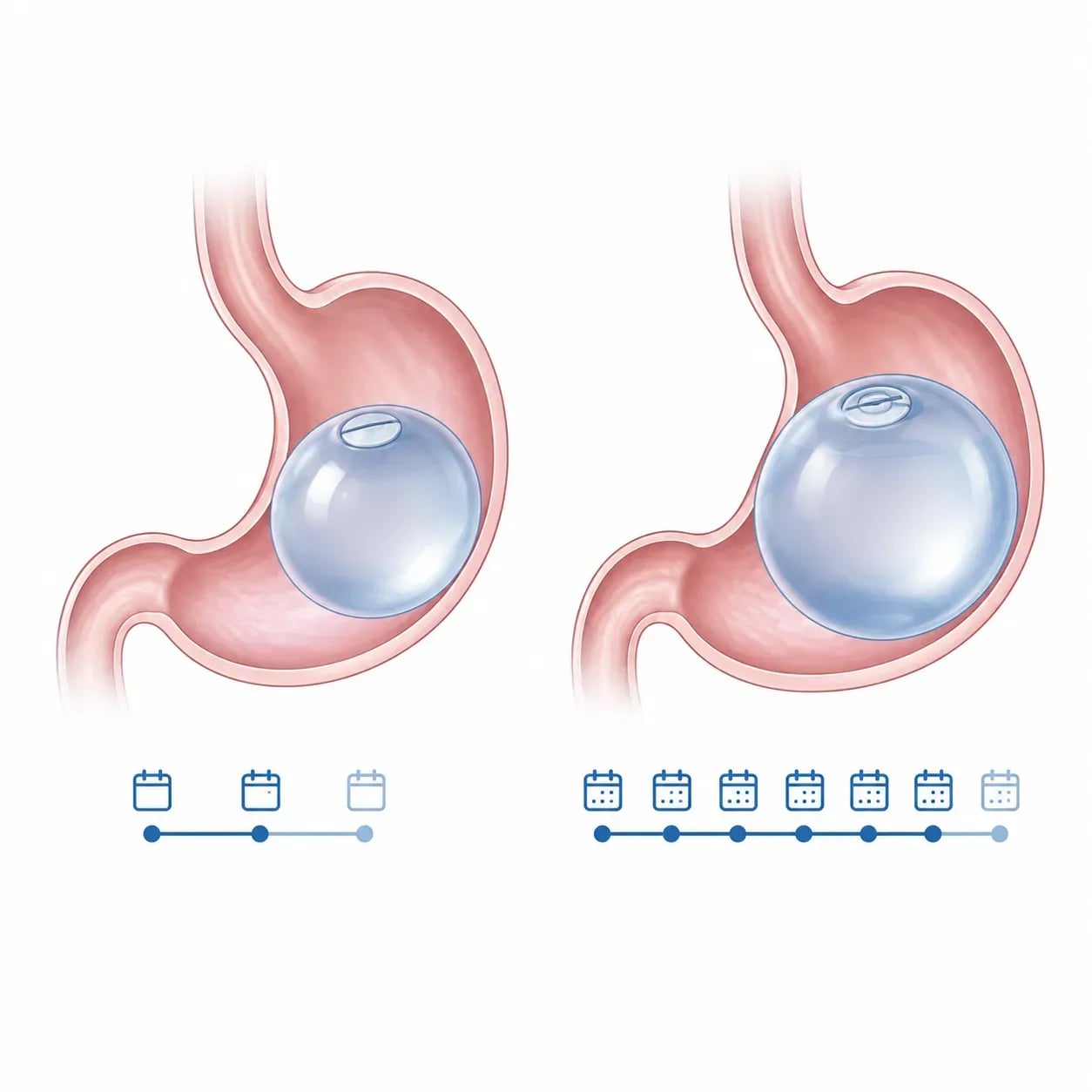 Comparaison des formules ballon gastrique 6 mois et 12 mois