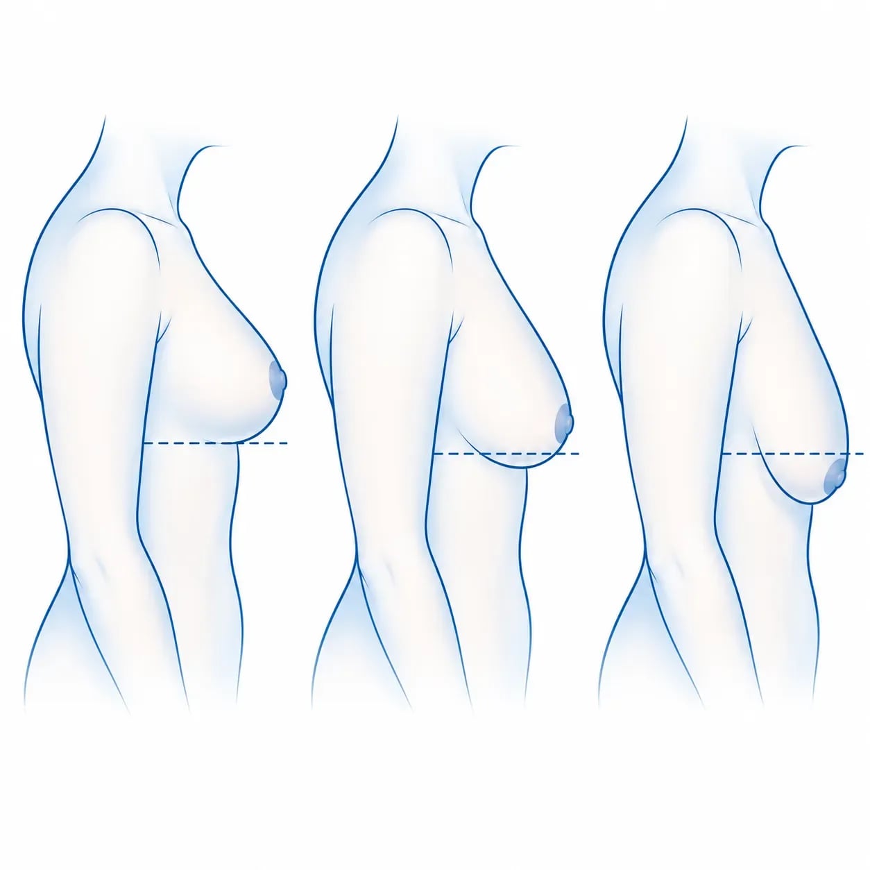 Diagramme des 3 grades de ptôse mammaire selon la position du mamelon