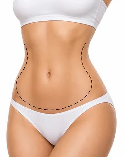 Liposuccion 360° de l’abdomen, de la taille, des flancs et du dos en Tunisie
