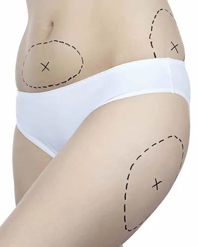 Liposuccion de plusieurs zones en Tunisie