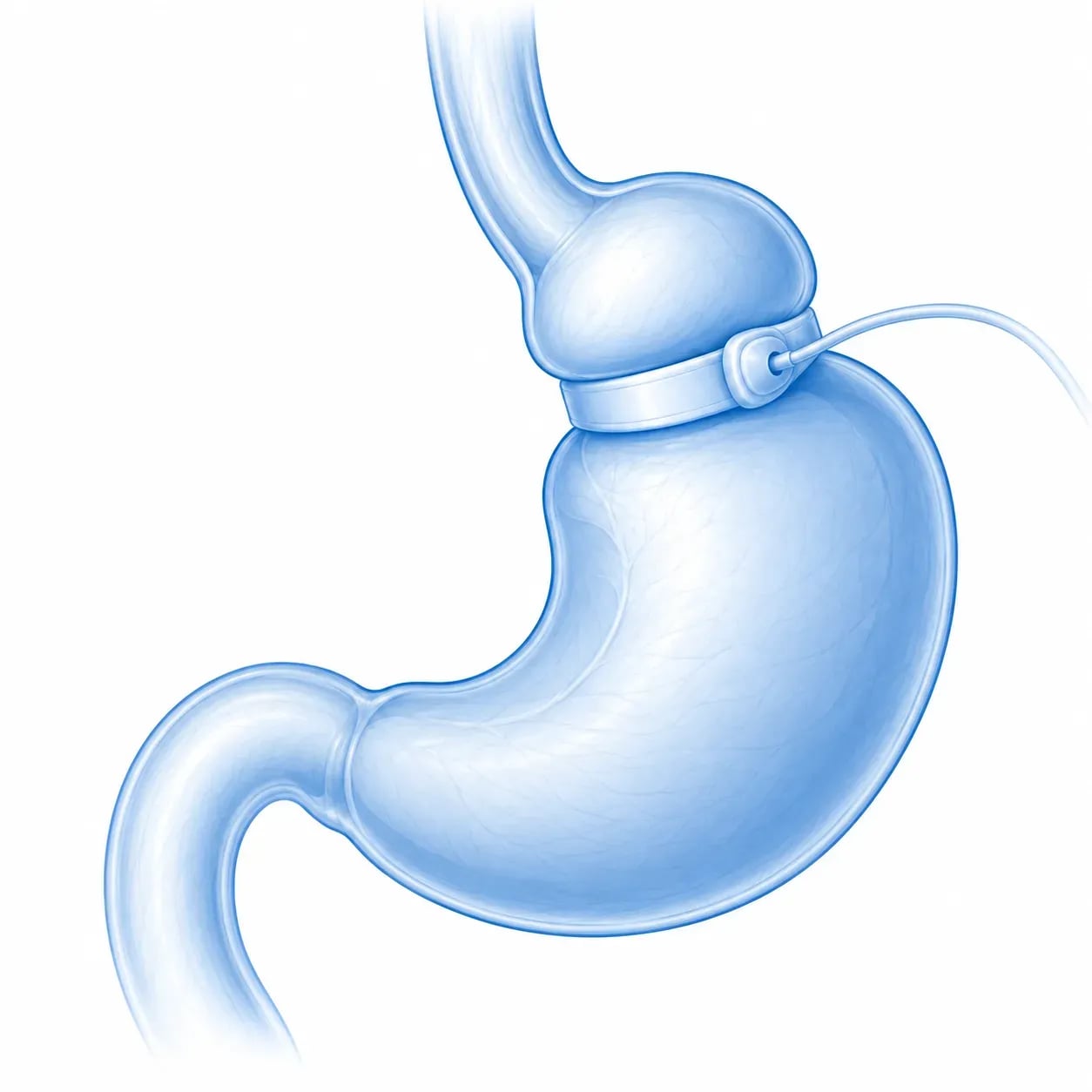 Schéma du mécanisme de l'anneau gastrique ajustable