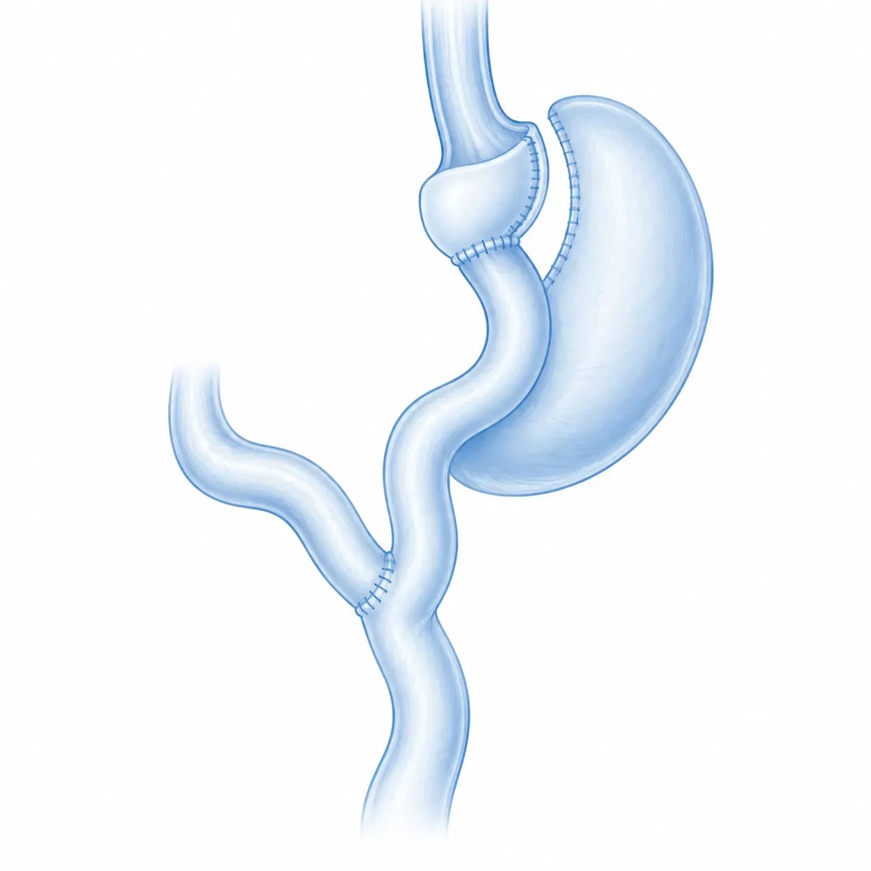 Schéma du mécanisme du bypass gastrique en Y