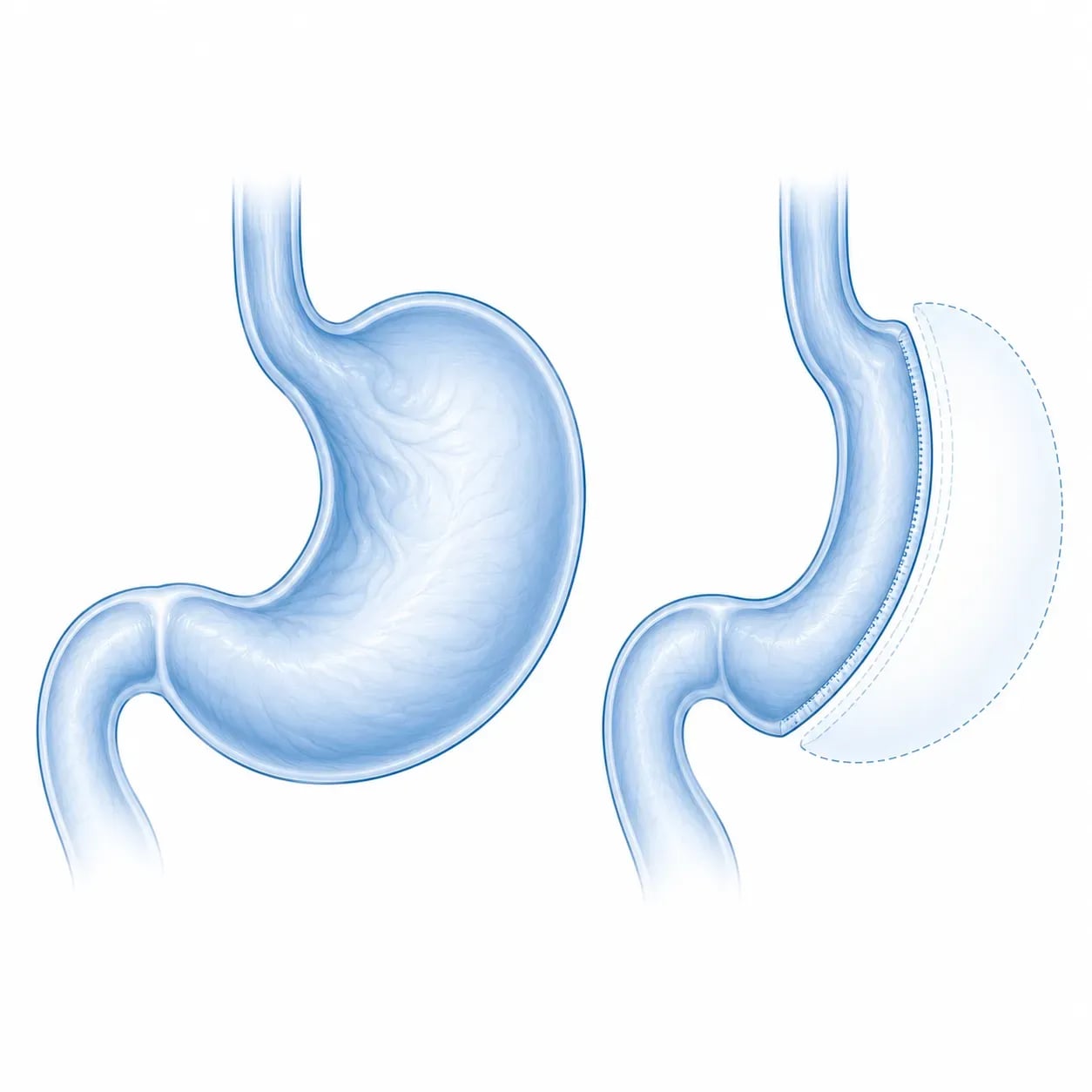 chéma du mécanisme de la sleeve gastrique : réduction du volume et effet hormonal