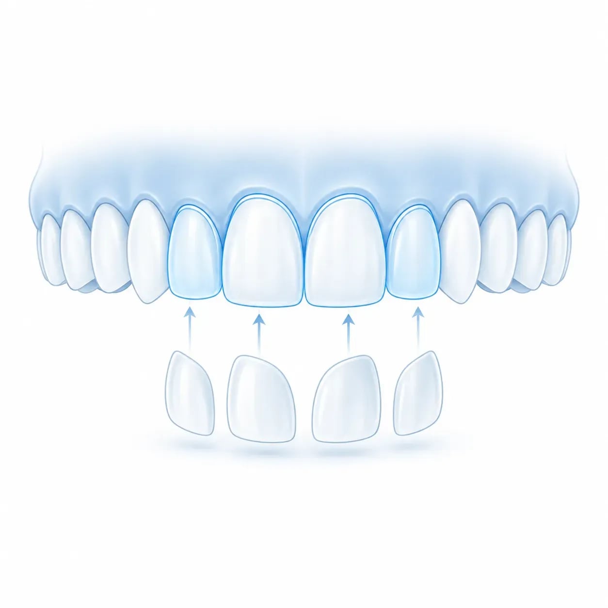 Illustration du nombre de dents généralement concernées par un sourire de facettes