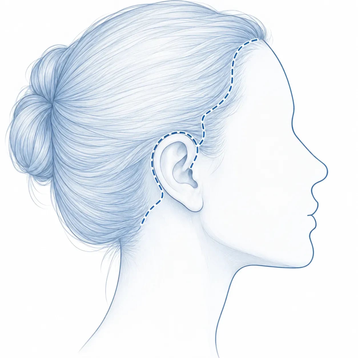 Schéma du positionnement discret des cicatrices d'un lifting du visage