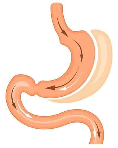 Sleeve gastrique en Tunisie, traitement chirurgical de l'obésité