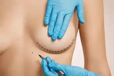 Chirurgie mammaire en Tunisie réalisée par un chirurgien spécialisé
