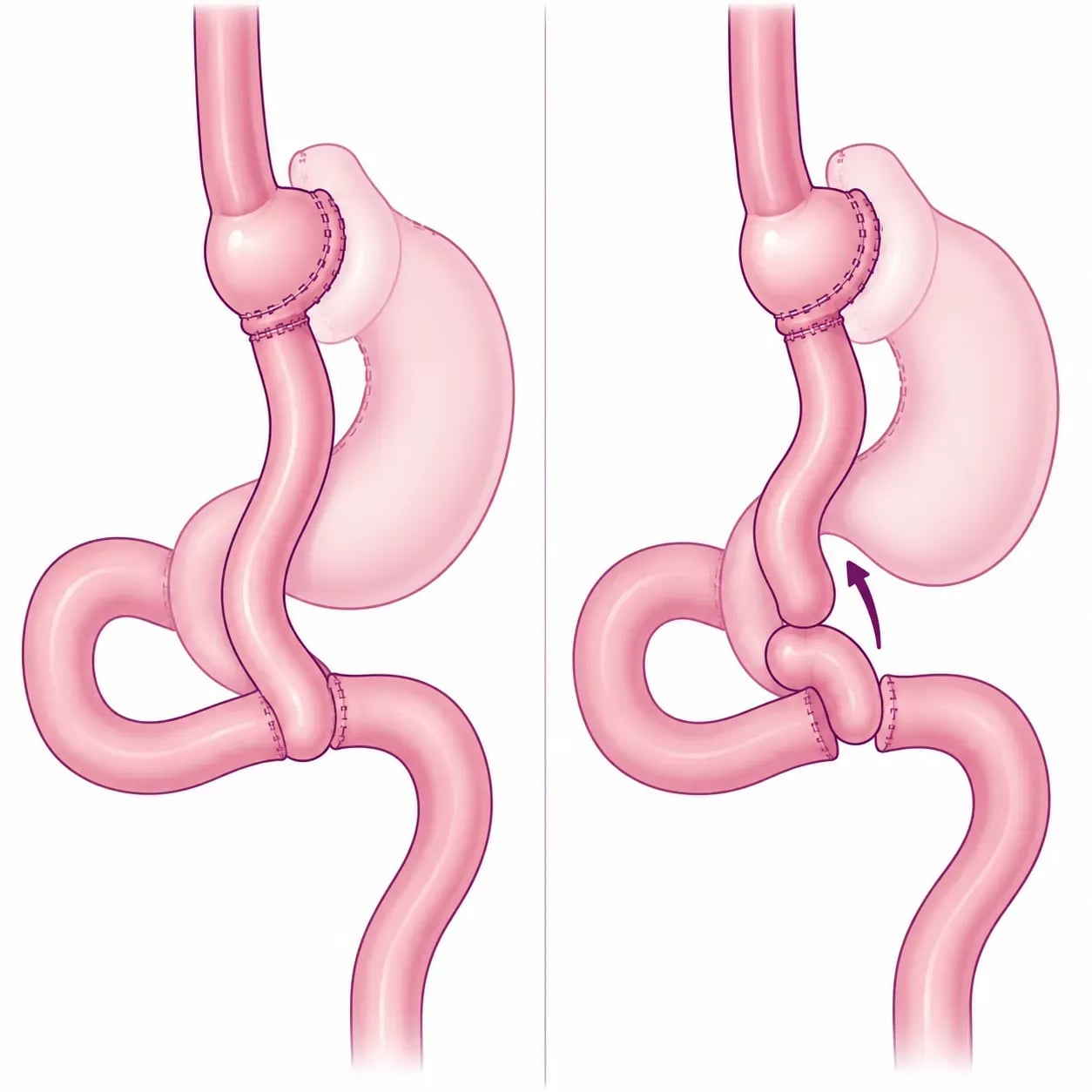 Hernie interne après un bypass gastrique : un espace s'ouvre entre les segments d'intestin avec la perte de poids