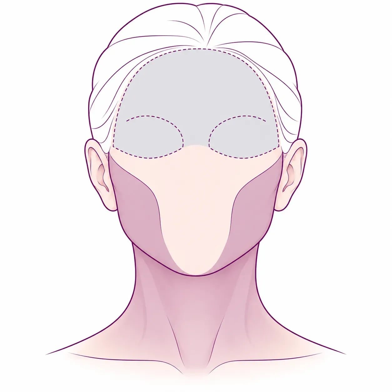 Zones traitées par un lifting du visage : tiers inférieur et cou, contrairement au front et aux paupières