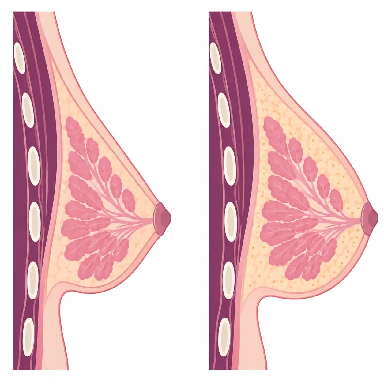 Gain de volume obtenu par lipofilling mammaire : une augmentation modérée d'une à deux tailles