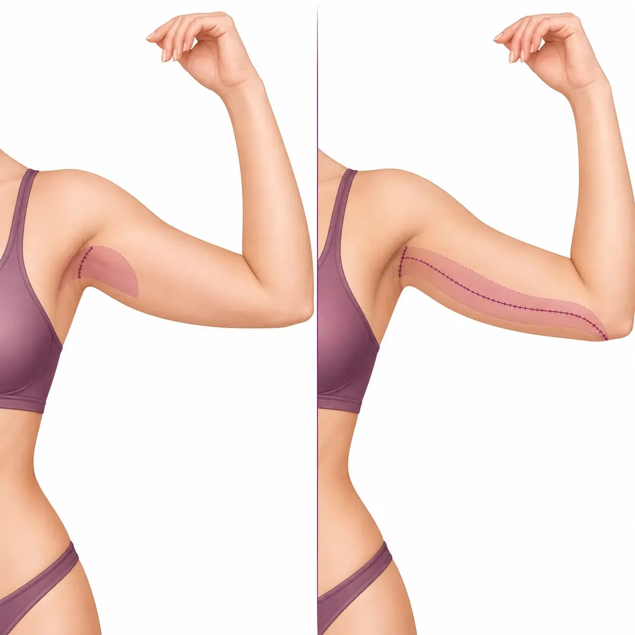 Comparaison entre un mini-lifting des bras et un lifting complet : longueur de la cicatrice