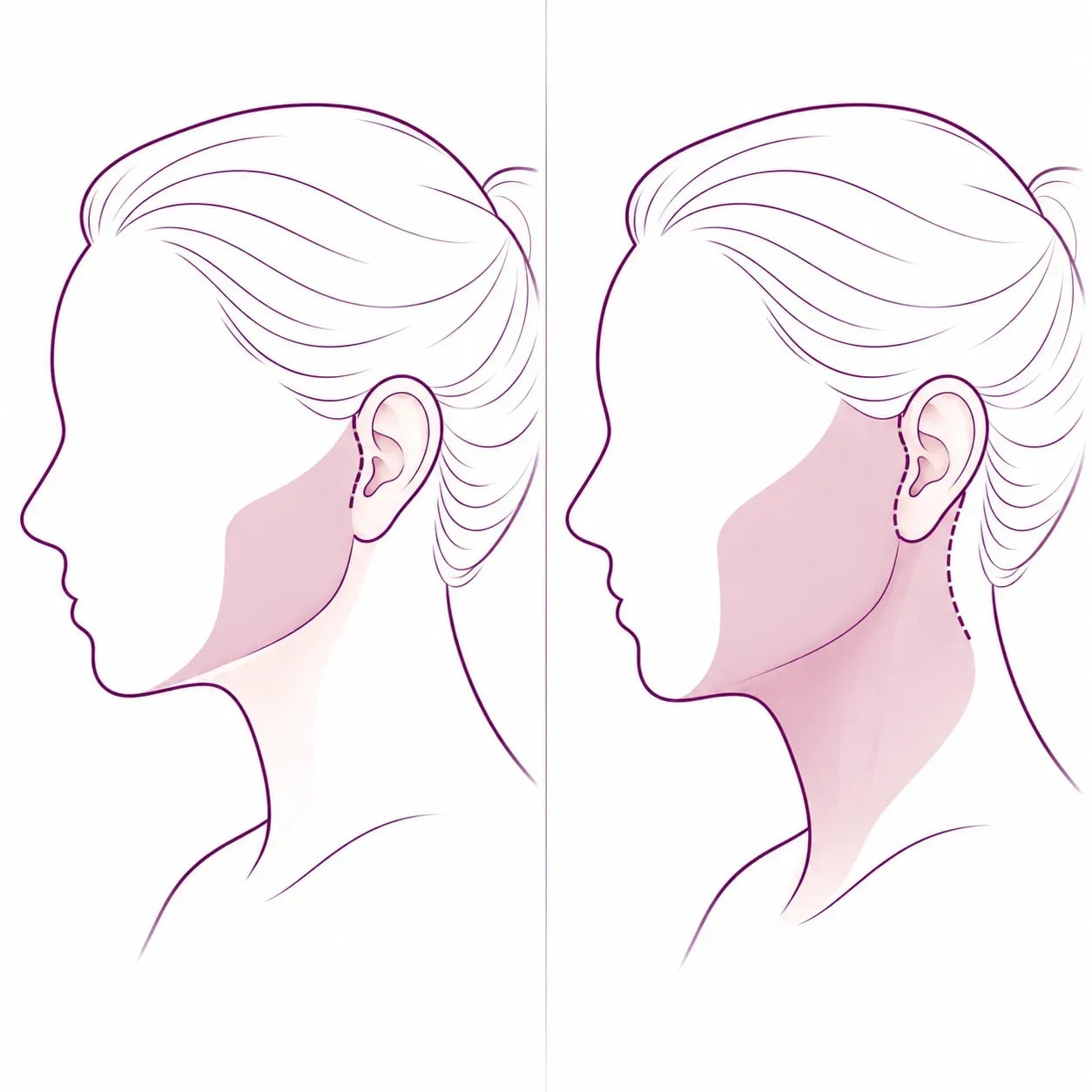 Différence entre un mini-lifting et un lifting cervico-facial complet : étendue traitée et longueur de cicatrice