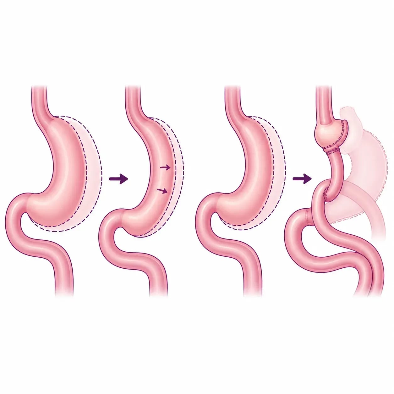 Reprise de sleeve gastrique : re-sleeve ou conversion en bypass