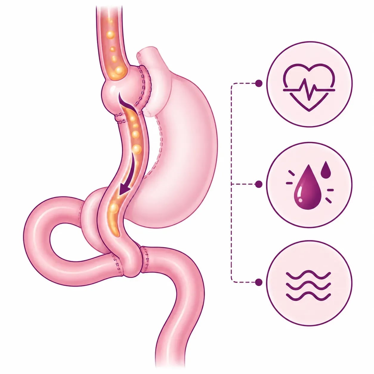Syndrome de chasse après un bypass gastrique : arrivée rapide des aliments dans l'intestin