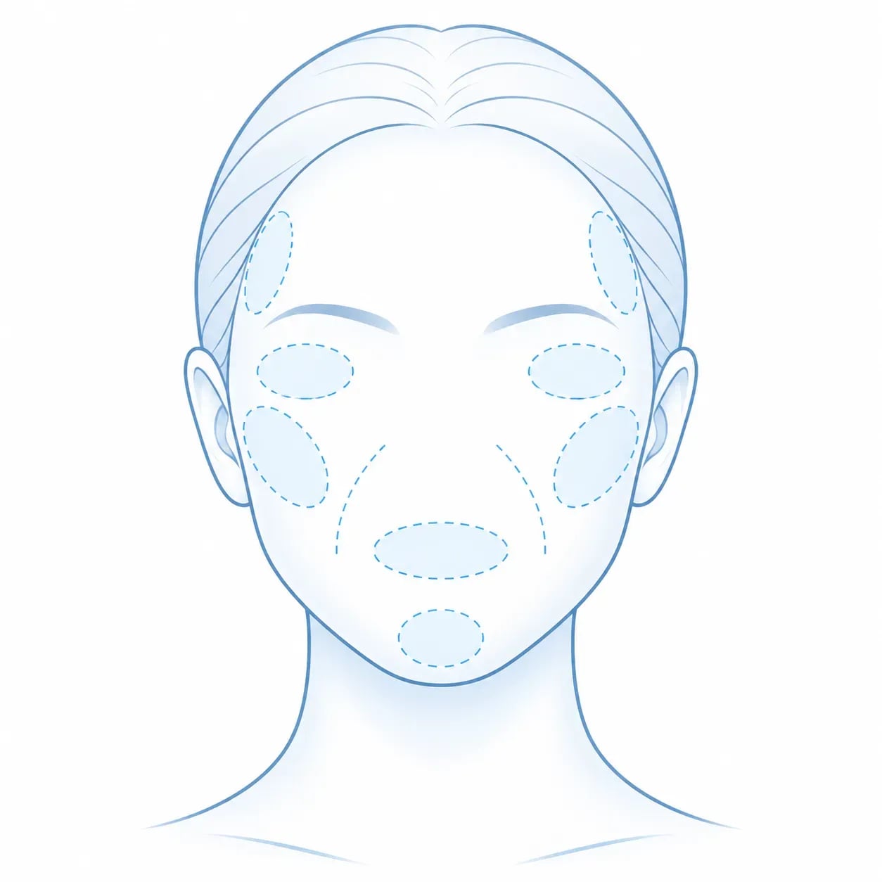 Schéma des zones du visage pouvant être traitées par comblement à l'acide hyaluronique