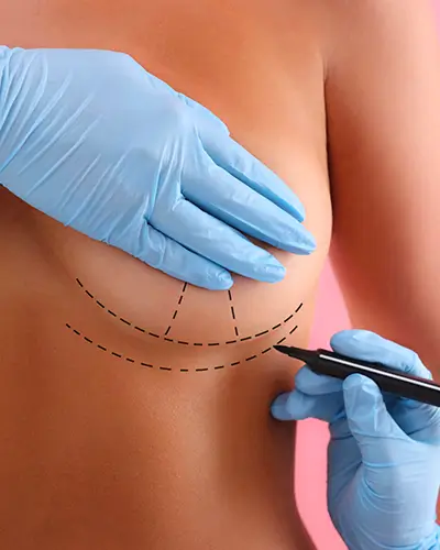 Breast Lift 1