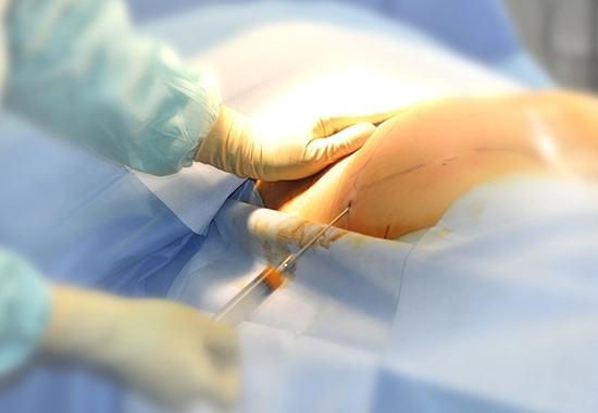 La Procédure du Lipofilling Fessier