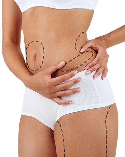Liposuction 2